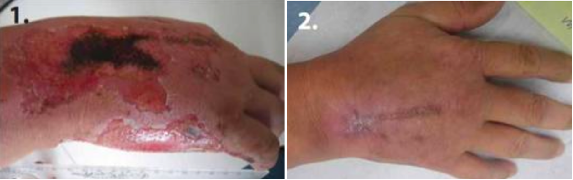 Day 1: Extensive traumatic abrasion on the hand with significant tissue damage. Day 71: Fully healed hand with restored skin integrity and minimal residual scarring.